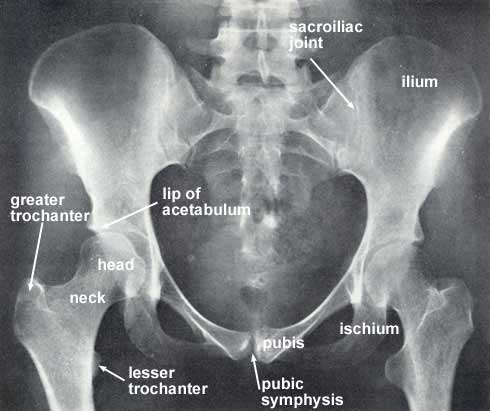 normal hip socket margins o0n xray