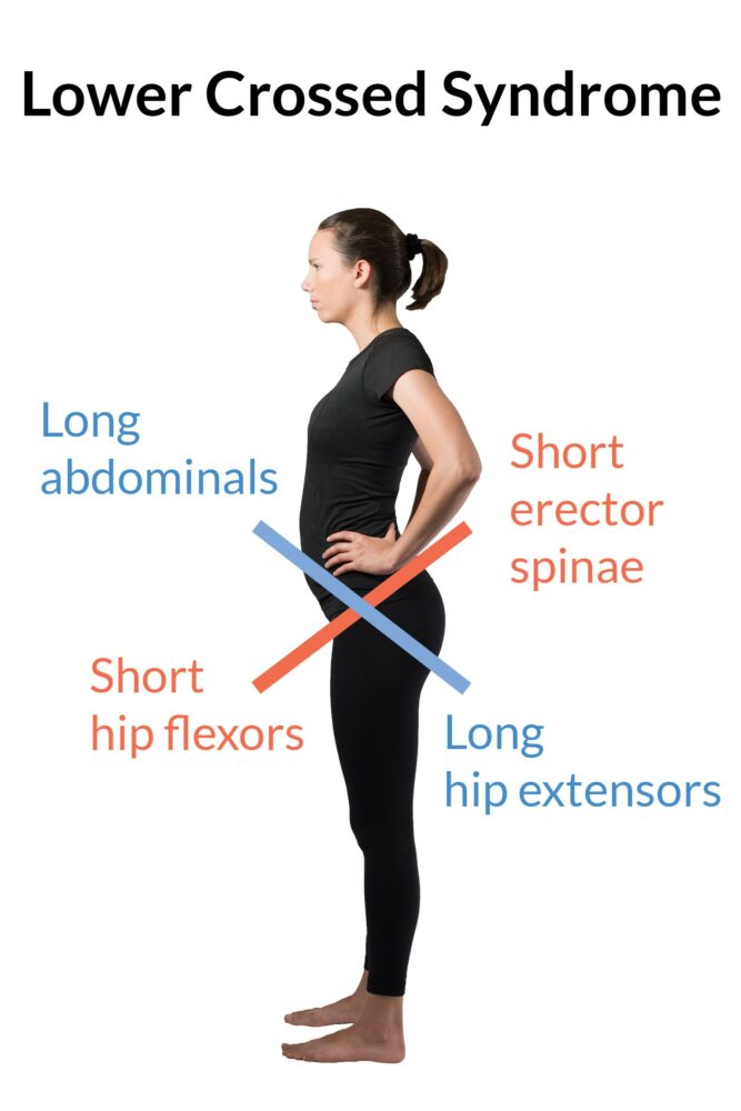 Lower crossed syndrome is characterized by a forward tilting of the pelvis, short erector spinae and hip flexor muscles, and long abdominal and hamstring muscles. This is often used as an explanation as to why people do quad stretches.