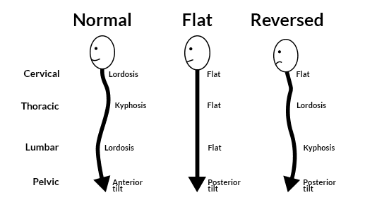 A comparison of normal, flat, and reversed spinal curves. A normal curve has a normal cervical lordosis, thoracic kyphosis, lumbar lordosis, and anterior pelvic tilt. A flat spine removes these curves with a posterior pelvic tilt. A reversed spine has the opposite curves.