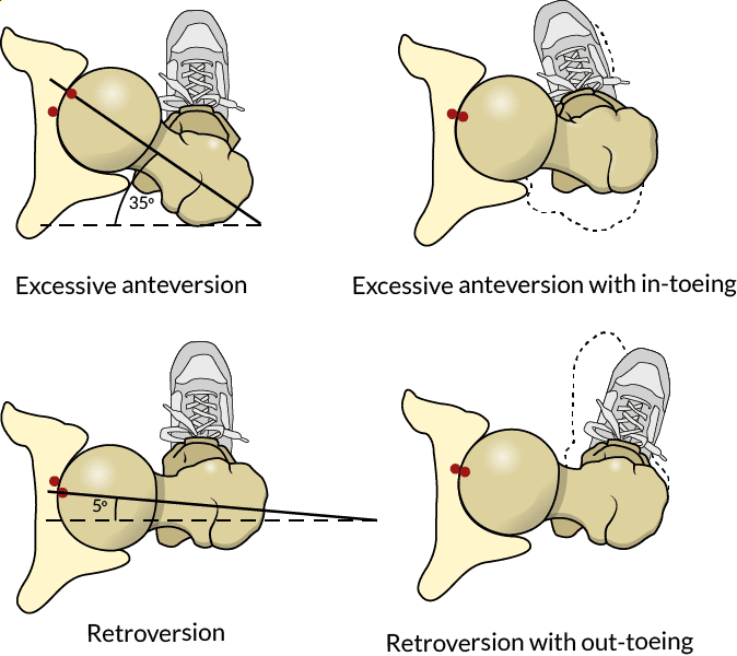 Four drawings showing hip anteversion corrected with hip internal rotation and in-toeing, plus hip retroversion corrected with hip external rotation and out-toeing