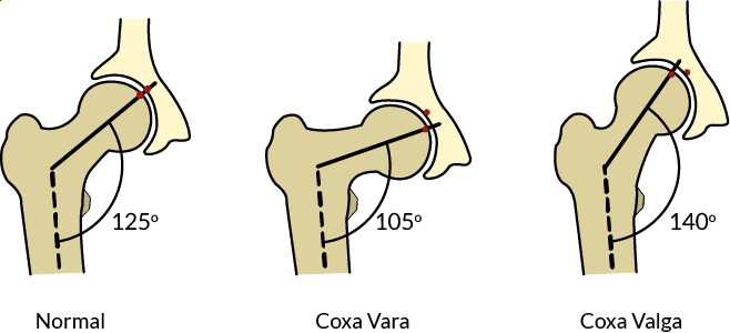 Three drawings showing three different angles of femoral neck inclination: a normal 125 degrees, coxa vara at 105 degrees, and coxa valga at 140 degrees. Coxa vara and valga increase the likelihood of butt wink.