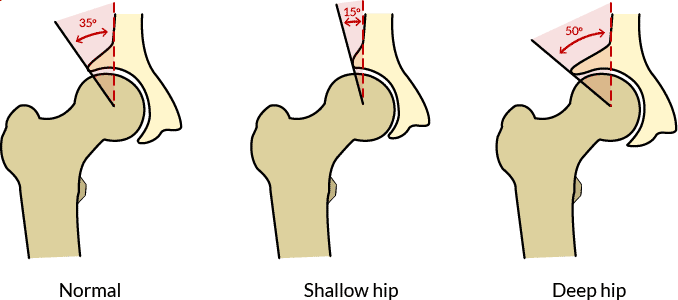 Three pictures showing a normal, shallow, and deep hip socket