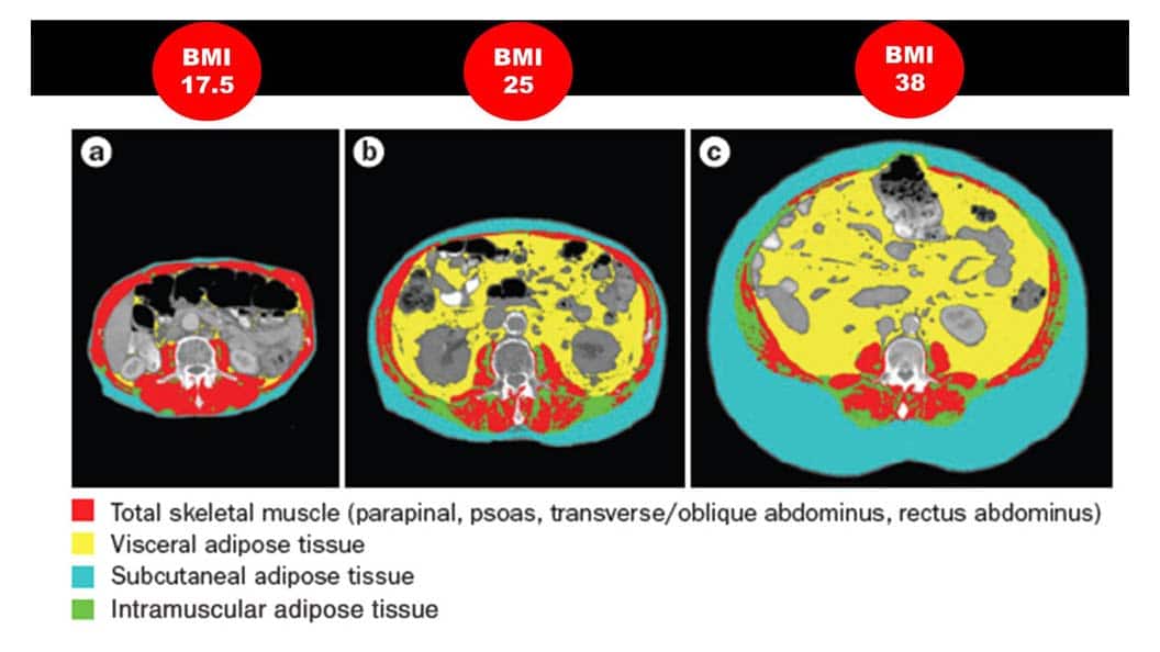 Abdominal computed tomography (CT) scan used to determine body composition