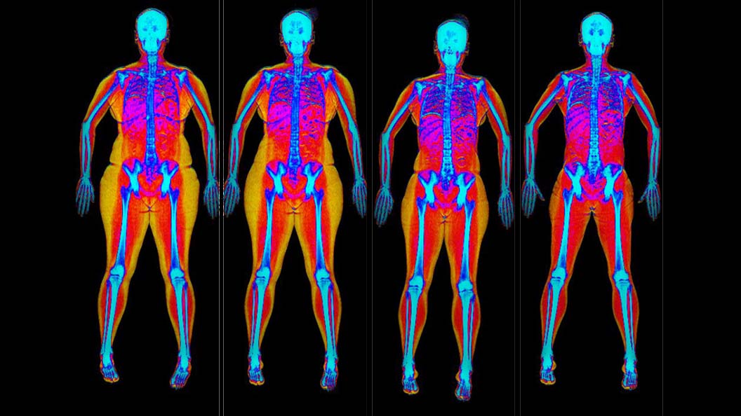 DEXA scan showing four progressive images of improved body composition