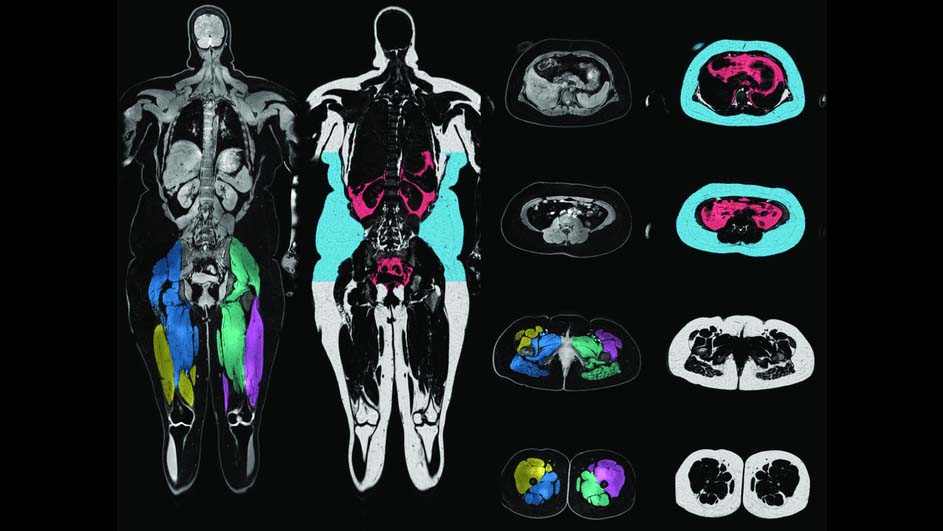 Magnetic resonance image (MRI) used to determine body composition