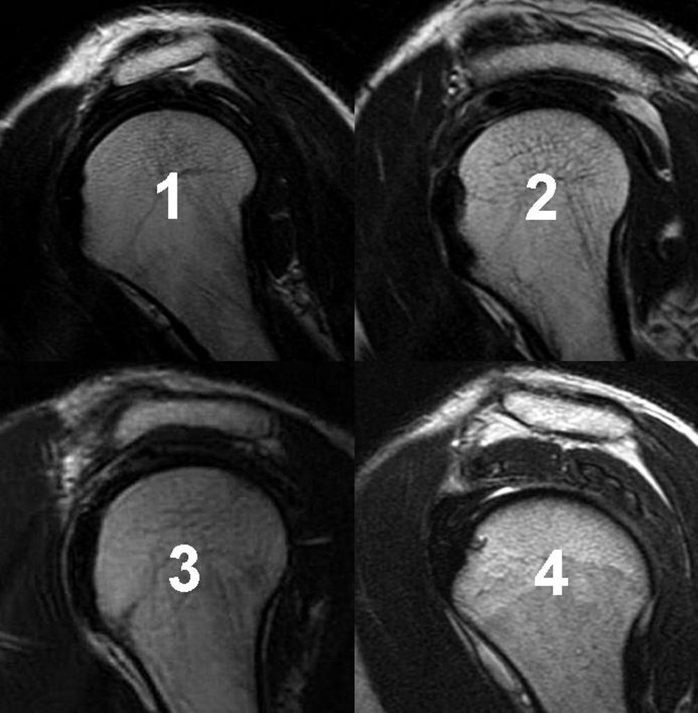 Four radiographs showing the different types of acromion processes